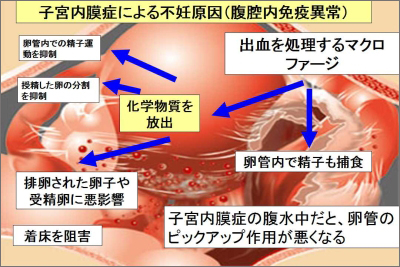 子宮内膜症と不妊症・全体像