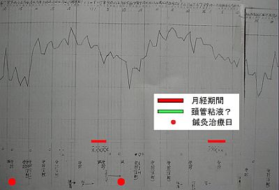 PCOS鍼灸を開始する前の基礎体温