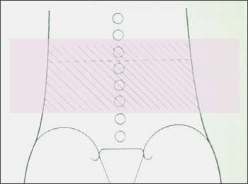 筋・筋膜性腰痛の起こる場所の図